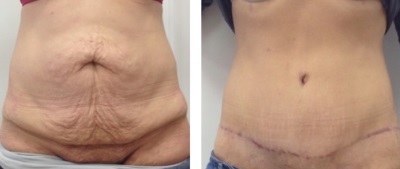 abdominoplastie Turquie avant apres