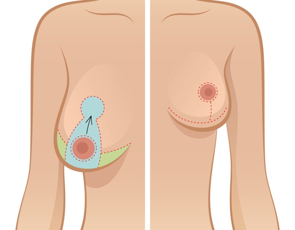 cicatrices reduction mammaire