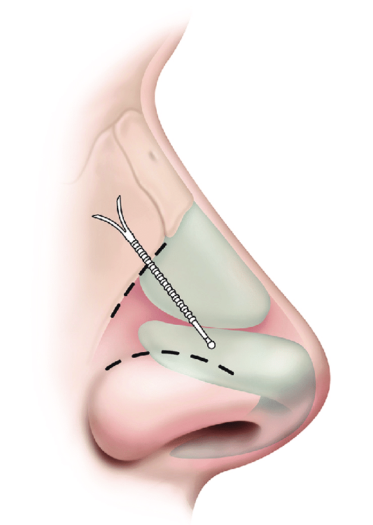 implant nasal