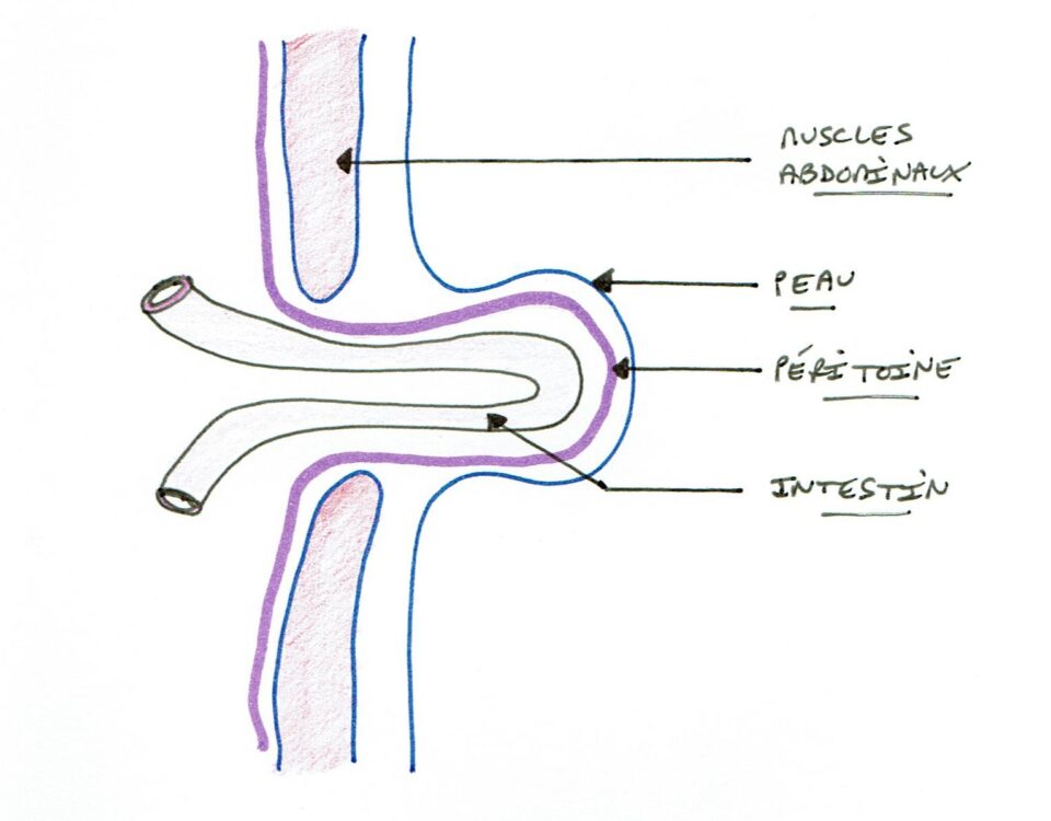 hernie-ombilicale